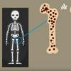 undefined Osteoporosis