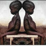 Podcast Desnutrición en niños en la Guajira