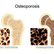 Podcast OSTEOPOROSIS