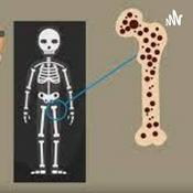 Podcast Osteoporosis